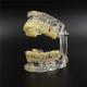 Dental Study Tooth Transparent Adult Pathological & Disease Teeth Model