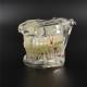 NEW Dental Implant Study Analysis Demonstration Teeth Model with Restoration