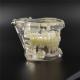 NEW Dental Implant Study Analysis Demonstration Teeth Model with Restoration