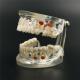 New Dental Study Teaching Model Disease Model Removable Teeth
