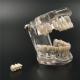 NEW Dental Implant Study Analysis Demonstration Teeth Model with Restoration 