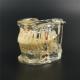 1 X  Dental Implant Disease Tooth Pathological Extrusion Missing Teeth Model