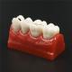 Dental Cavity Sealing Demonstration tooth Model teeth study