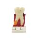 4:1 Dentist Dental Study Teach Tooth Model Teeth Disease Model Free Ship