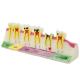 Dental Caries Developing illusteation Tooth Model Demonstration Teach Patient