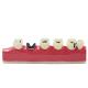 Dental Caries Developing illusteation Tooth Model Demonstration Teach Patient