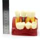 MACRO IMPLANT MODEL CROWN BRIDGE DEMOSTRATATION TEETH TOOH TYPODONT DENTOFORM