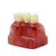 MACRO IMPLANT MODEL CROWN BRIDGE DEMOSTRATATION TEETH TOOH TYPODONT DENTOFORM