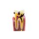 Oral Model 4 Times Dental Caries Comparison Model Dental Tooth Model