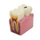 Oral Model 4 Times Dental Caries Comparison Model Dental Tooth Model