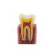 Oral Model 4 Times Dental Caries Comparison Model Dental Tooth Model