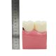 Oral Model 4 Times Dental Caries Comparison Model Dental Tooth Model